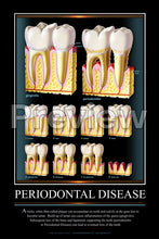 Load image into Gallery viewer, Periodontal Disease Wall Chart