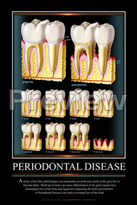 Periodontal Disease Wall Chart